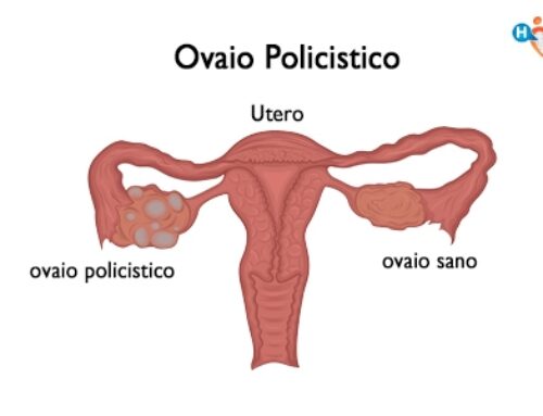 SINDROME DELL’OVAIO POLICISTICO (PCOS)